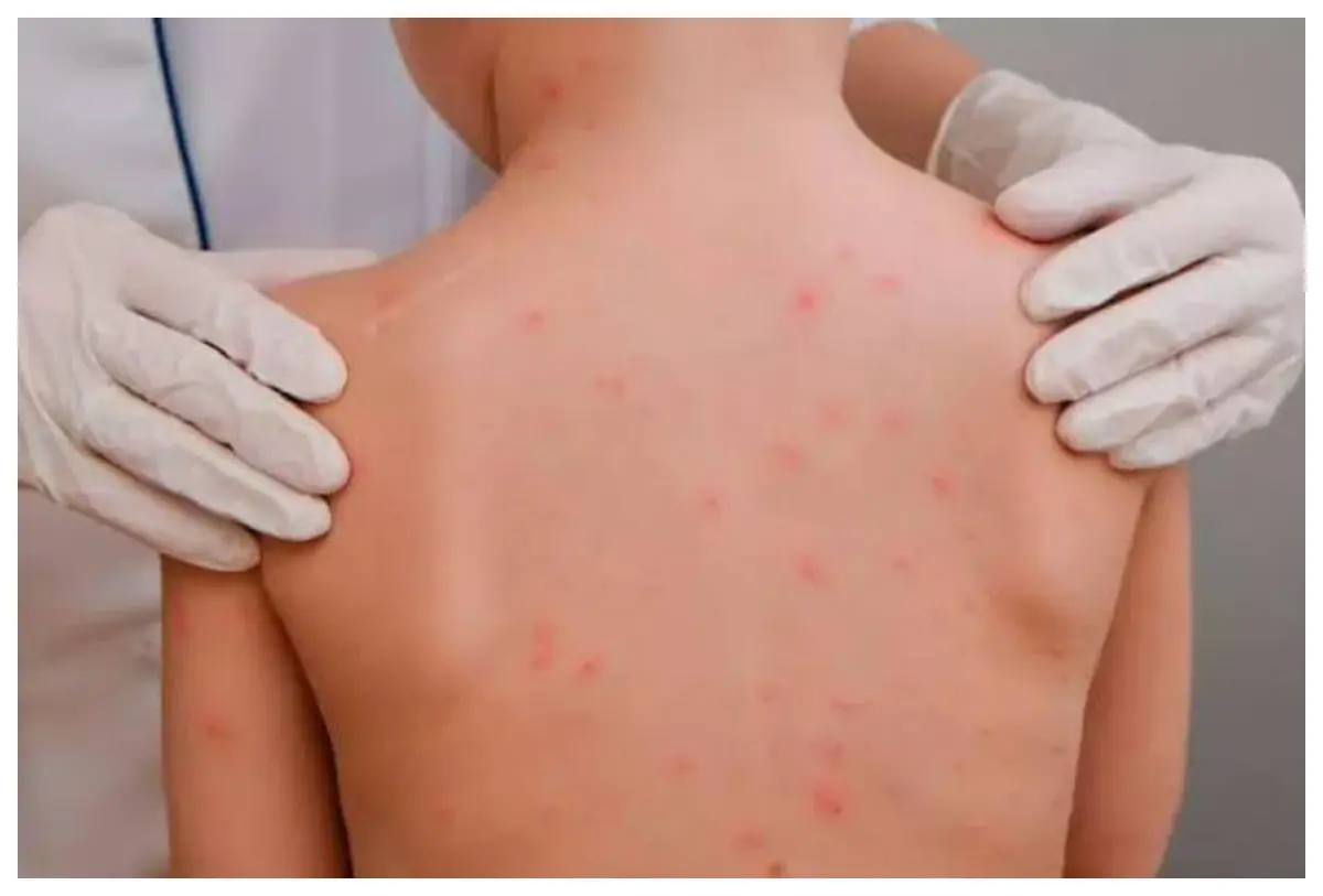 Bahía de Banderas reporta un tercer caso de sarampión y intensifica la vacunación puerta a puerta