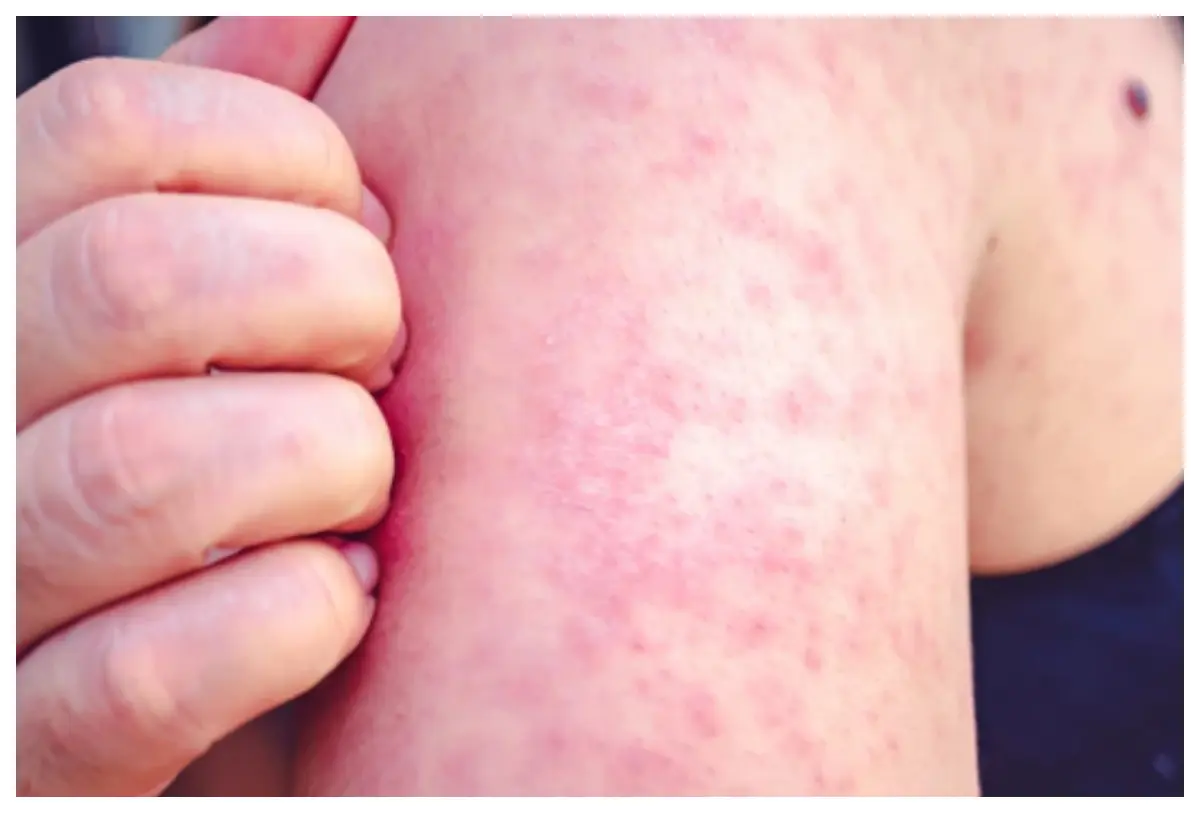 México reporta 24 fallecidos y cerca de seis mil contagios de sarampión