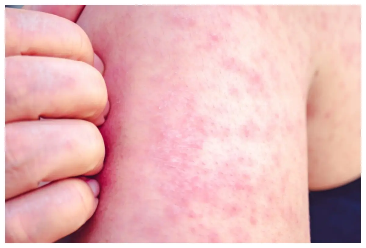 Sarampión en Bahía de Banderas: Confirman contagio en Valle Dorado y establecen cerco sanitario